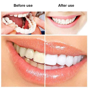 Perfect Smile Snap-On Braces