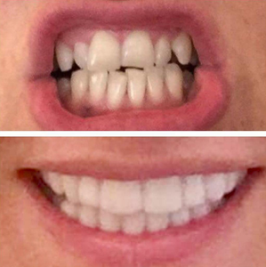 5 Reasons Why You Should Get Perfect Smile Snap-On Braces for 2021