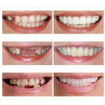 Load image into Gallery viewer, Snap-On Brace False Teeth Veneers
