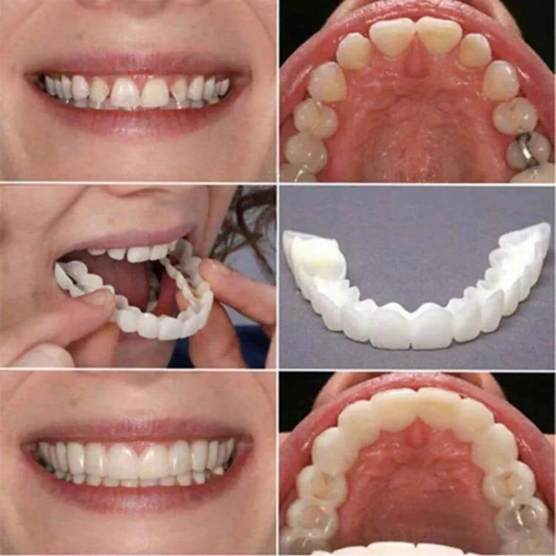 Magic Teeth Brace Veneers